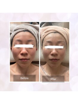 エメカシワ(Aimer KASHIWA)/フェイシャル　1回での変化