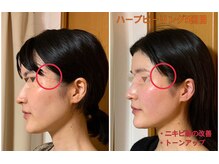 ブプラ 代々木上原店(BUPURA)/ハーブピーリング×肌荒れ改善