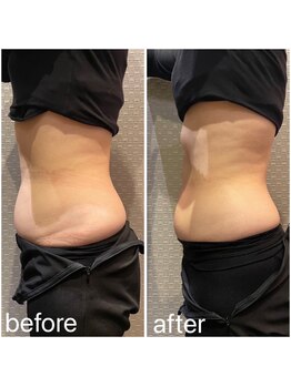 ビュウナ 銀座(BEAUNA)/脂肪冷却/frozen8