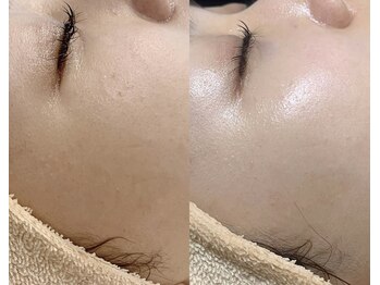 サロンユウ/ツヤ肌リフトエステ