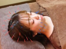 アルバ暁子鍼灸治療院(alba暁子鍼灸治療院)/美容鍼