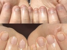 セラキュアネイル(Theracure nail)