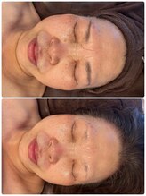 ラナ(Lana)/【セルマンピーリング】1回☆