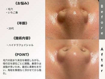 ルディラ 新宿店/ハイドラフェイシャル