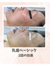 リンフェイス 浦安店(RINFACE)/乾燥や赤みにも
