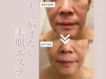 リボーン(Reborn)/70代 エイジングケア(1年1ヶ月)