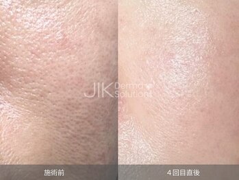 レディラックビューティー 横浜(Lady Luck beauty)/毛穴開きにもおすすめ★