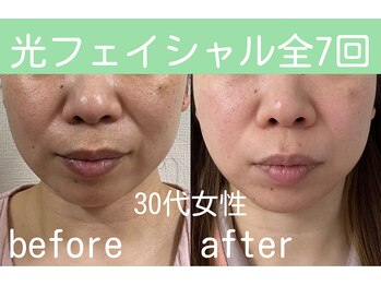 キワミ サーティスリー(kiwami33)/光(フォト)フェイシャル