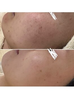 ハーナウ ハウ(hanau hou)/ハーブピーリング効果