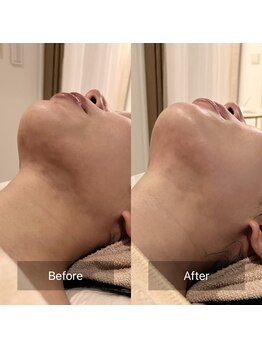 アラマンダ(Allamanda)/あご下BeforeAfter