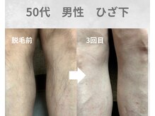 バーム(BAAM)/施術経過