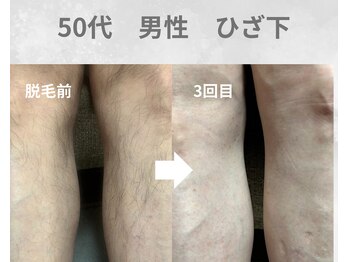 バーム(BAAM)/施術経過