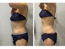 ラヴィエール(Laviere)/【レディース痩身120分】7回目