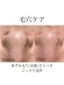 【黒ずみ&ザラつき徹底毛穴洗浄】水素ハイドラフェイシャル＋美容液導入