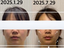 ベール(BEHL)/コルギのBefore After