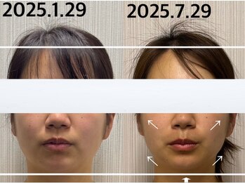 ベール(BEHL)/コルギのBefore After