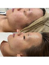 ダリア(Dahlia)/スターターターハーブ×プラズマ