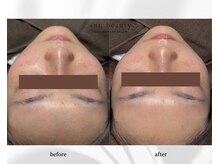 アン ビューティー(ann beauty)/施術1回【症例写真】10代