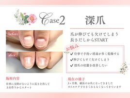 3ヶ月の変化　深爪育成