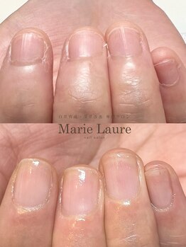 マリーロール 梅田店(Marie Laure)/自爪育成/深爪矯正/ネイルケア