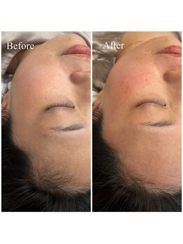 ホワイトワックス 京都四条烏丸(WHITE WAX)/《全顔》フェイシャルワックス