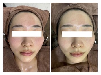 ホワイトアクア 北千住店(WHITE AQUA)/ハーブピーリング/肌質改善/毛穴