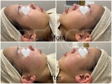 ピース(PEACE)/クリスティーナ アンストレス1回