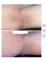ペア(pe'a)/脱毛before★after[脇]