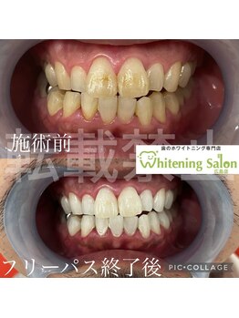 ホワイトニングサロン 広島店/【ホワイトニング施術例】