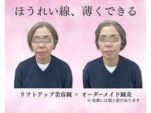 望鍼灸院の雰囲気（ビフォーアフター【シワ／ほうれい線／たるみ／肩こり／美容鍼】）