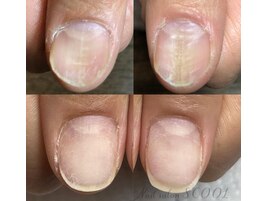 トラブル爪解消