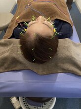 トラスト整骨院鍼灸院/鍼灸/美容鍼/小顔/リフトアップ