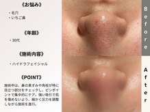 ルディラ 新宿店/ハイドラフェイシャル