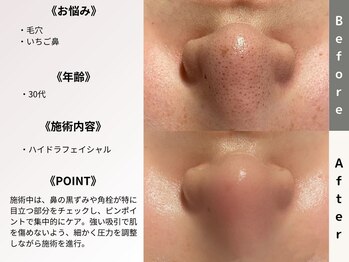 ルディラ 新宿店/ハイドラフェイシャル