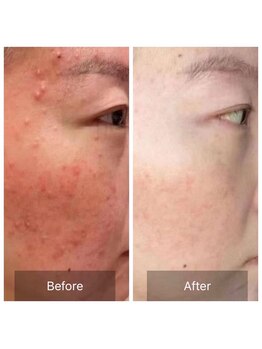 ボディーシェルター 横浜桜木町/ダイヤモンドピール