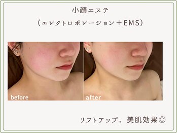 べセラ(BESERA)/小顔エステ 1