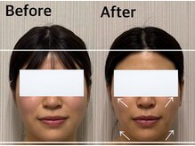 ベール(BEHL)/コルギ５回目のBefore After