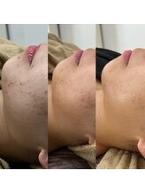 ダリア(Dahlia)/スターターターハーブ×プラズマ