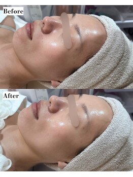 ソワナ(soina)/【神楽坂駅/フェイシャル/毛穴】