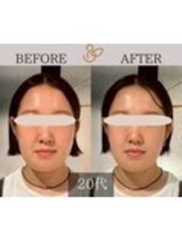 チョコバリ 錦糸町店(chocobari)/小顔×リフトアップ(美容鍼)20代