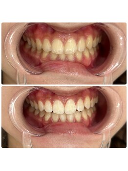 コナホワイトニング 神保町/ホワイトニング