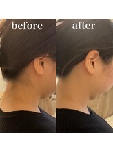 ミノア 熊本店(MINOA)/うなじ脱毛◆ビフォーアフター