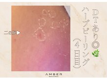 アンバー 恵比寿(AMBER)/DT有ハーブピーリング