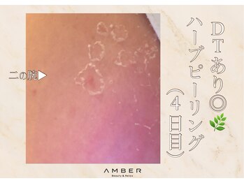 アンバー 恵比寿(AMBER)/DT有ハーブピーリング