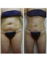 ダリア(DALIA)/お腹のサイズダウン