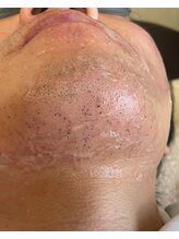 ルアナラウンジ(Luana Lounge)/【症例】　ヒゲ脱毛