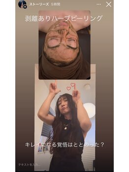 ジーニー(Genie)/リベル ハーブピーリング