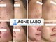 アクネラボ 梅田店(ACNE LABO)の写真