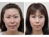 5名のみ限定!小顔・顔の歪み改善継続モニター(60分)