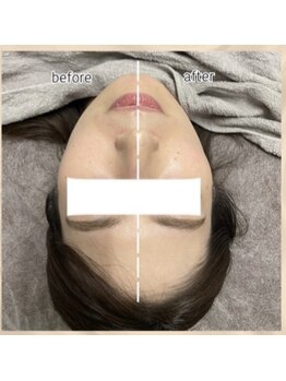 エンチャント(ENCHANT)/小顔造形超音波リフト